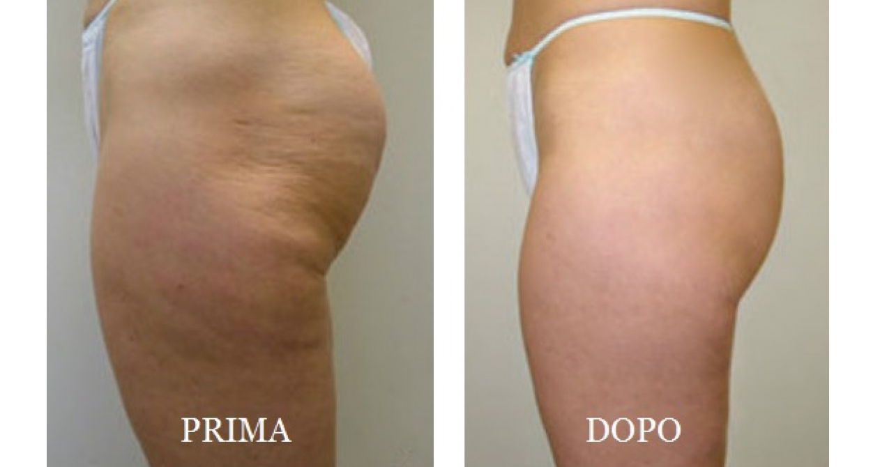 eliminare la cellulite definitivamente