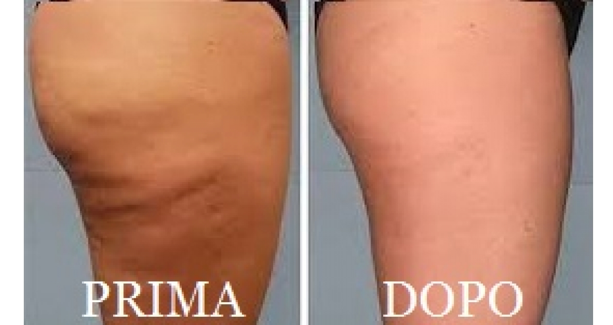 eliminare la cellulite definitivamente