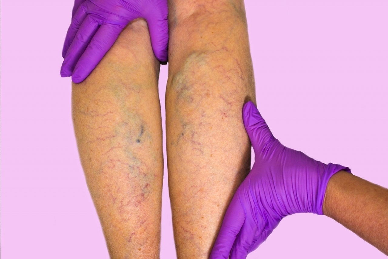 Pregatirea medicamentelor varicoase - Tratamentul venelor varicoase pe picioare cu medicamente