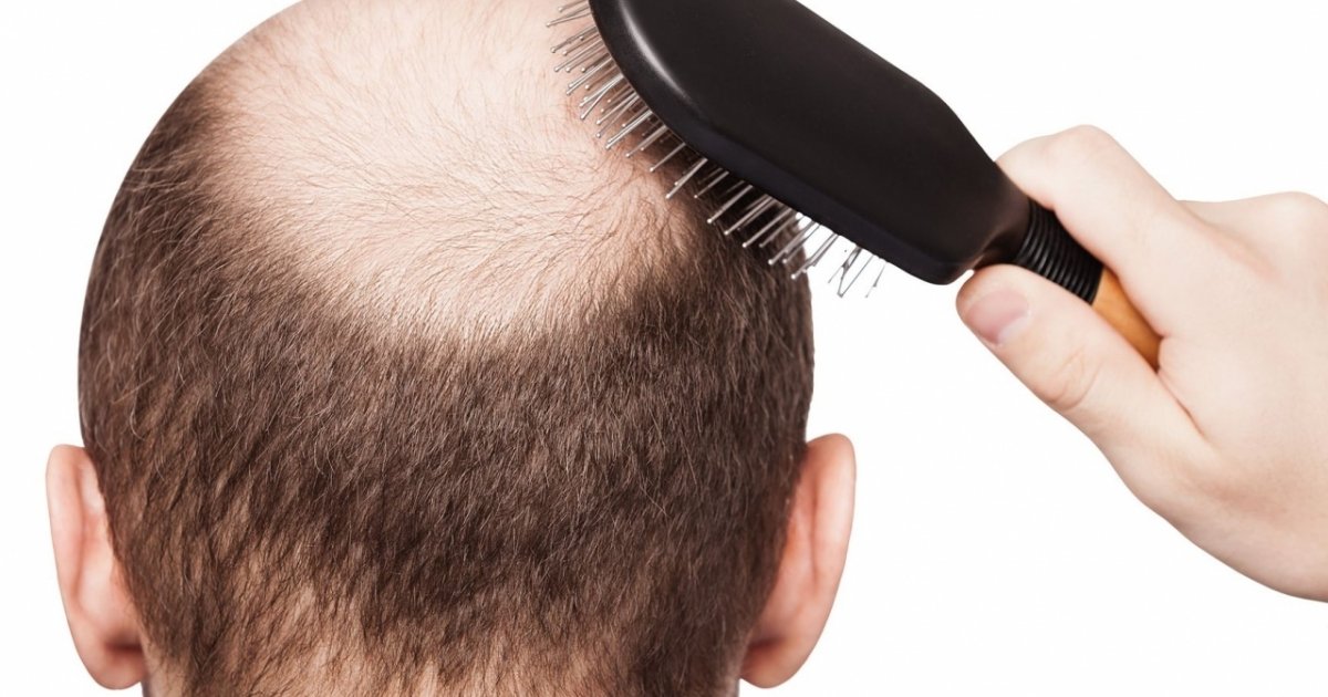 Cura calvizie 2020 Cura calvizie 2020