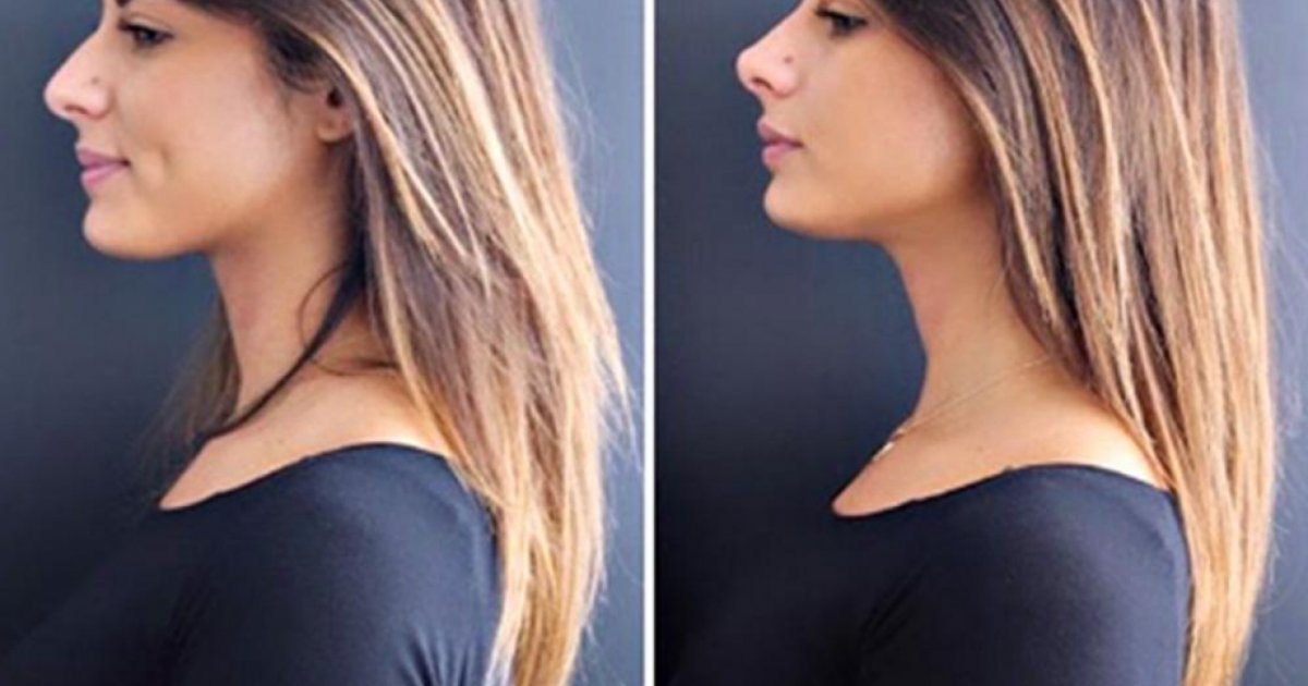 Naso Nuovo Per Giulia Cavaglia Ho Fatto Un Rinofiller Ticinonline