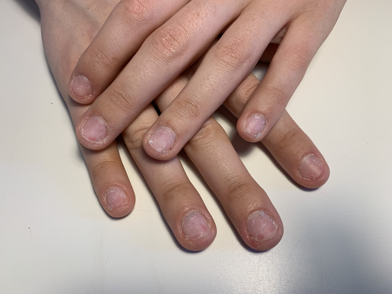 Ricostruzione Unghie E Unghie Rotte Ticinonline