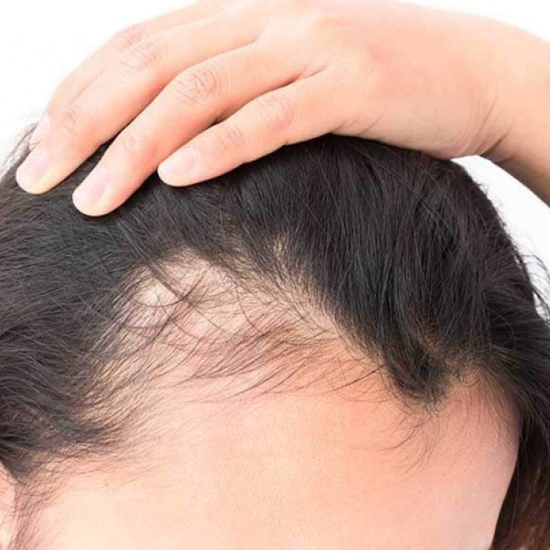Caduta Di Capelli Anomala A Ciocche O Chiazze L Alopecia Ai Tempi Del Covid 19 Ticinonline