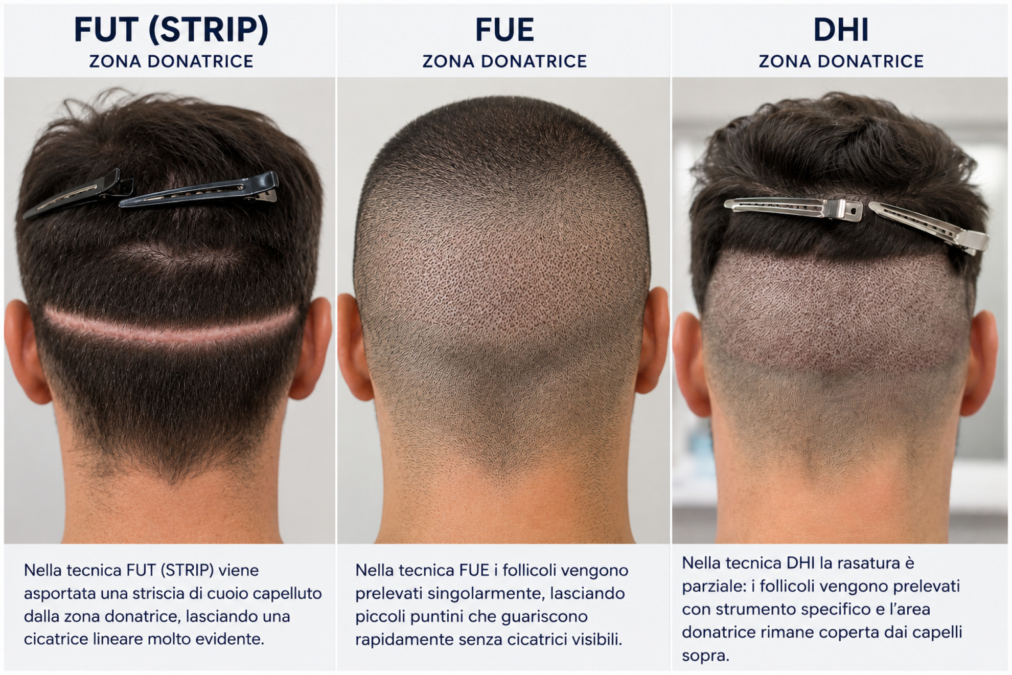 FUE, FUT o DHI: quale tecnica di trapianto scegliere (e perc