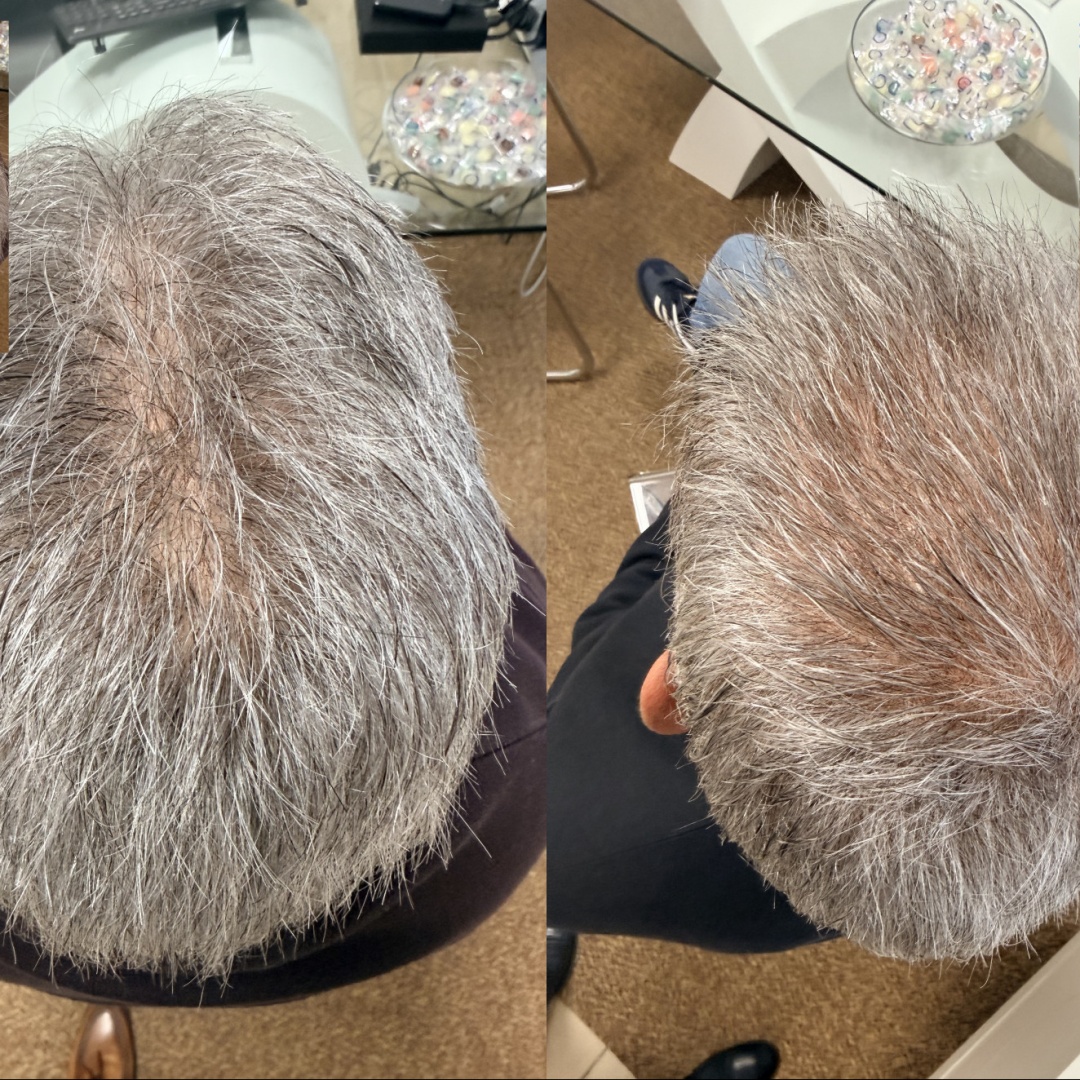 Quanto è davvero invisibile un infoltimento di capelli non chirurgico?