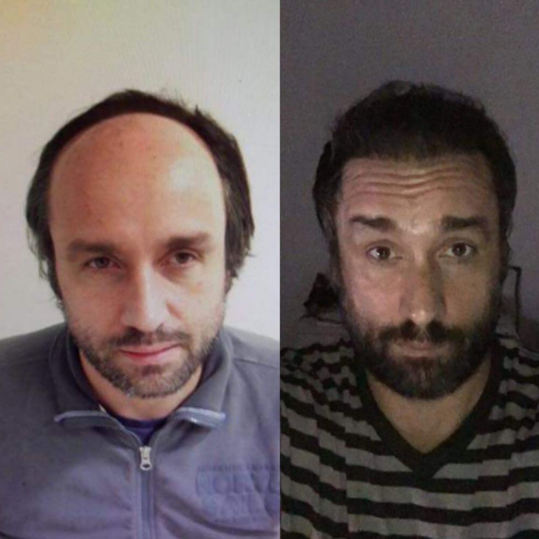 Trapianto di capelli: cosa succede prima, durante e dopo l’intervento