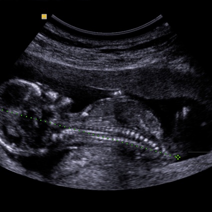 Gravidanze a rischio con idrope fetale e sindrome dello specchio