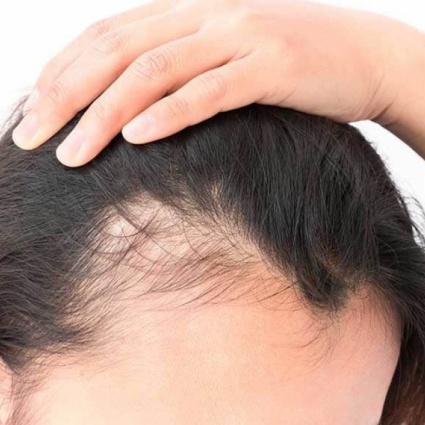 Caduta di capelli anomala a ciocche o chiazze? L’alopecia ai tempi del Covid-19