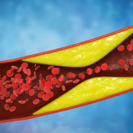 Aterosclerosi: cause, sintomi e cure