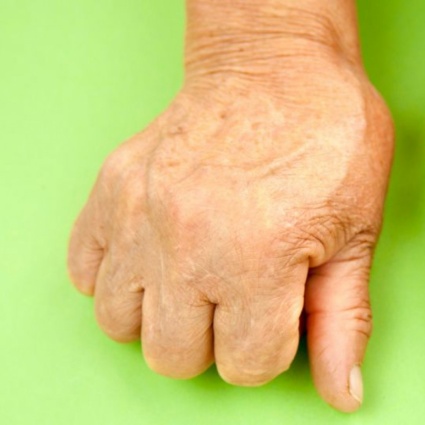 Artrite reumatoide: sintomi e rimedi