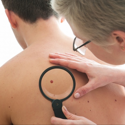 Melanoma day, una giornata dedicata alla prevenzione
