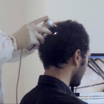 Alopecia da stress o psicogena