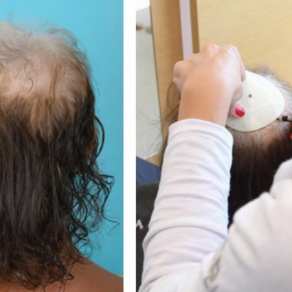 SOS problema di perdita capelli?