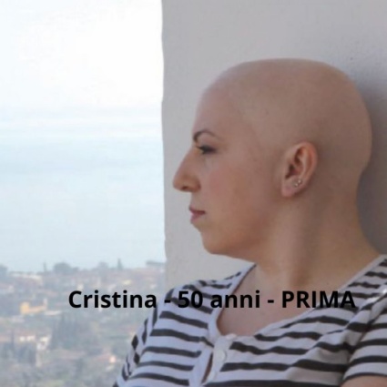 Perdita di capelli: La Rivoluzione é a Lugano con CRL-CNC