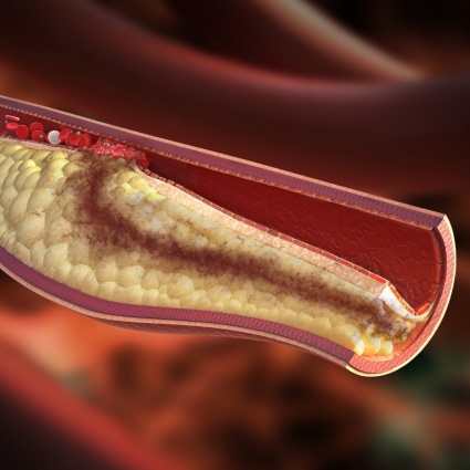 L'arteriosclerosi