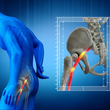 Hai un forte dolore al gluteo e formicolio alla gamba? Attento alla sindrome del piriforme