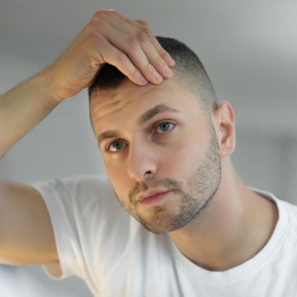 A che età conviene fare un trapianto di capelli?