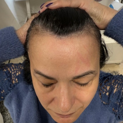 Trapianto di capelli per le donne: si può fare!