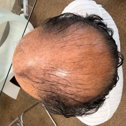Quanto è naturale al tatto un impianto di capelli moderno?