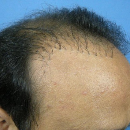 Trapianto di capelli mal riuscito: si può correggere?
