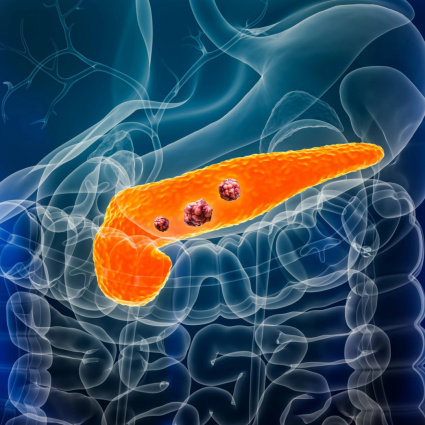 Tumore del pancreas, un esame del sangue per la diagnosi precoce