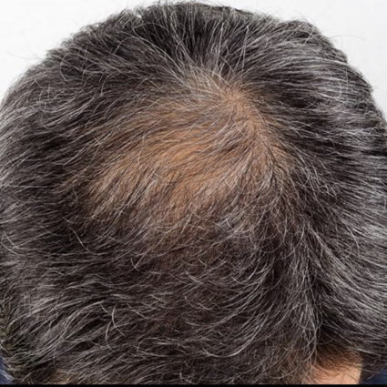 Terapia di mantenimento: perché il trapianto da solo spesso non basta