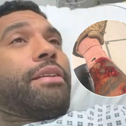Ex star della Premier League violentemente attaccata da un cane: «Spaventoso»