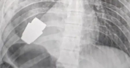 Un granata inesplosa estratta dal corpo di un soldato