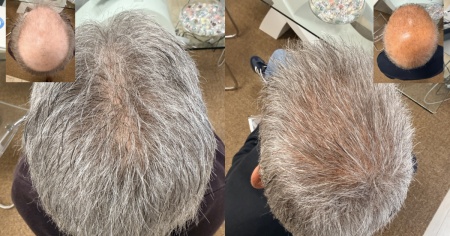 Quanto è davvero invisibile un infoltimento di capelli non chirurgico?