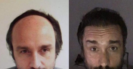 Trapianto di capelli: cosa succede prima, durante e dopo l’intervento