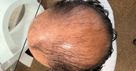 Quanto è naturale al tatto un impianto di capelli moderno?