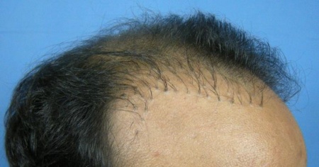 Trapianto di capelli mal riuscito: si può correggere?