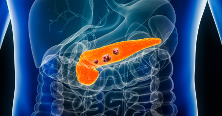 Tumore del pancreas, un esame del sangue per la diagnosi precoce