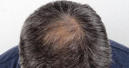 Terapia di mantenimento: perché il trapianto da solo spesso non basta