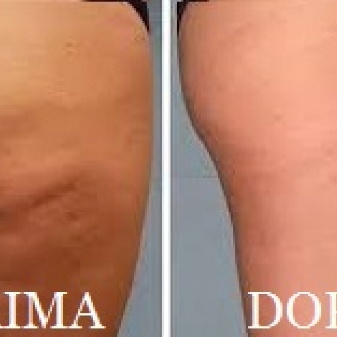eliminare la cellulite definitivamente